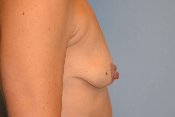 Breast Augmentation Before & After Gallery - Patient 173577863 - Image 7