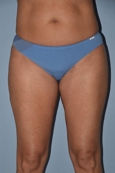 Liposuction Before & After Gallery - Patient 173577866 - Image 2