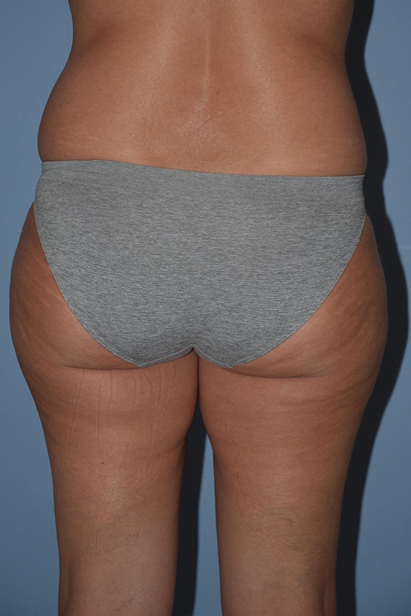 Liposuction Before & After Gallery - Patient 173577866 - Image 3