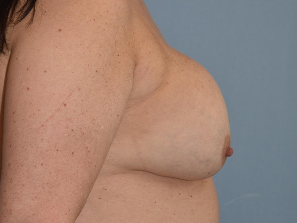 Breast Lift Before & After Gallery - Patient 173577868 - Image 9