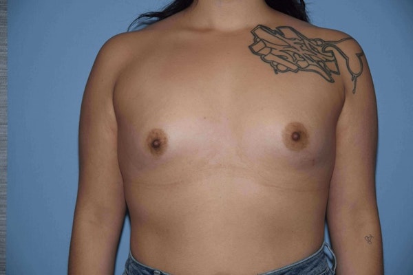 Breast Augmentation Before & After Gallery - Patient 173577874 - Image 1