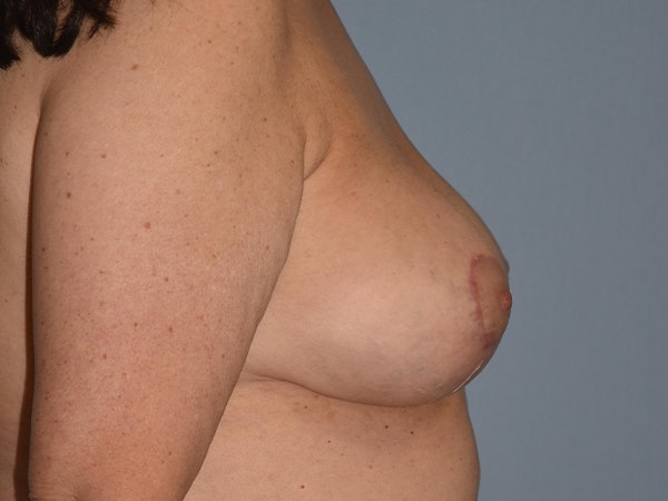 Breast Lift Before & After Gallery - Patient 173577868 - Image 10