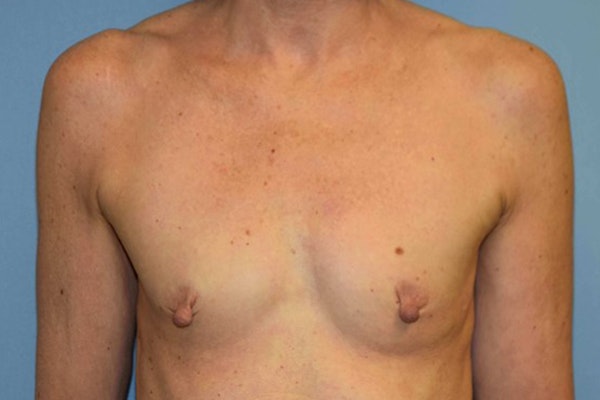 Breast Reconstruction Before & After Gallery - Patient 173577871 - Image 1