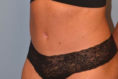 Tummy Tuck Before & After Gallery - Patient 173577872 - Image 6
