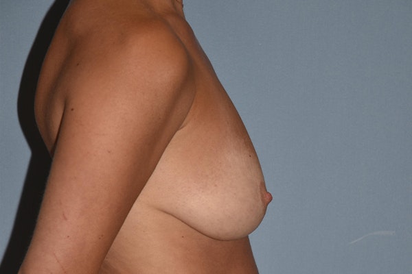 Breast Augmentation Lift Before & After Gallery - Patient 173577875 - Image 9