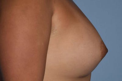 Breast Augmentation Before & After Gallery - Patient 173577874 - Image 6