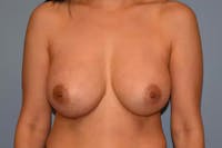 Breast Implant Removal Before & After Gallery - Patient 173577879 - Image 1