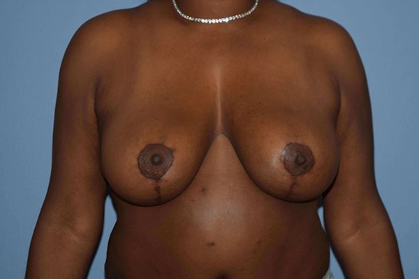 Breast Reduction Before & After Gallery - Patient 173577909 - Image 2