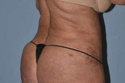 Liposuction Before & After Gallery - Patient 173577876 - Image 6
