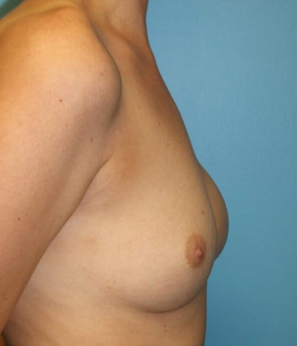 Breast Revision Before & After Gallery - Patient 173577878 - Image 5