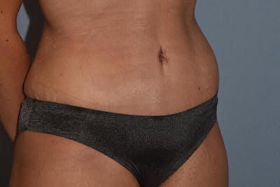 Tummy Tuck Before & After Gallery - Patient 173577880 - Image 4