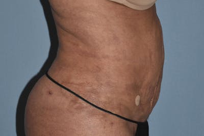 Liposuction Before & After Gallery - Patient 173577876 - Image 8