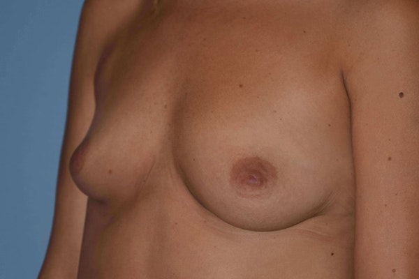 Breast Augmentation Before & After Gallery - Patient 173577906 - Image 5