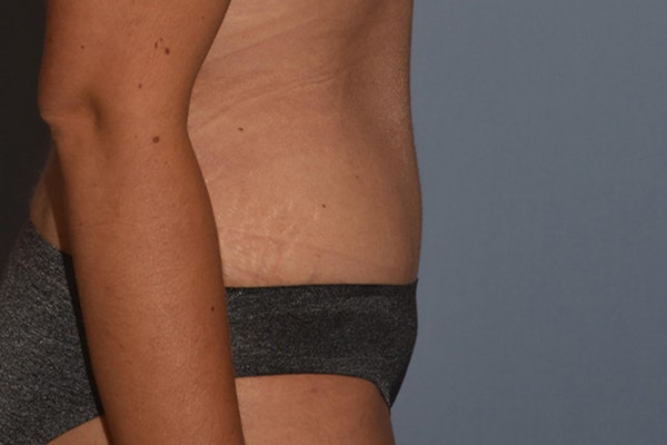 Tummy Tuck Before & After Gallery - Patient 173577880 - Image 6
