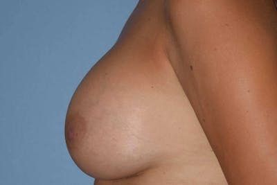 Breast Augmentation Before & After Gallery - Patient 173577906 - Image 8