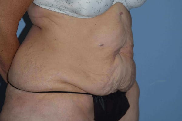 Tummy Tuck Before & After Gallery - Patient 173577913 - Image 3