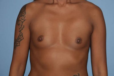 Breast Augmentation Before & After Gallery - Patient 173578633 - Image 1