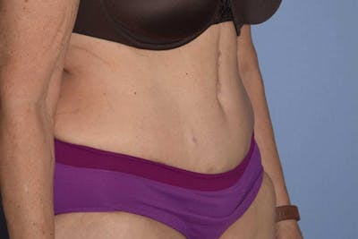 Tummy Tuck Before & After Gallery - Patient 173577913 - Image 4