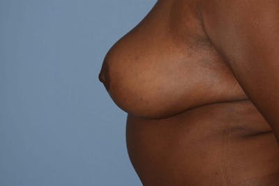 Breast Reduction Before & After Gallery - Patient 173577909 - Image 10