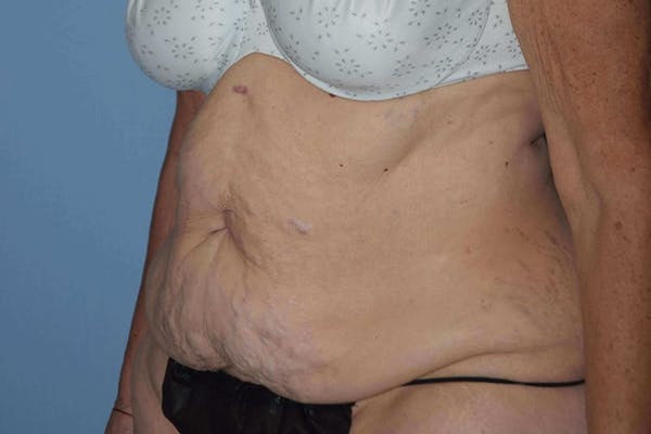 Tummy Tuck Before & After Gallery - Patient 173577913 - Image 5
