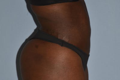 Liposuction Before & After Gallery - Patient 173577912 - Image 6