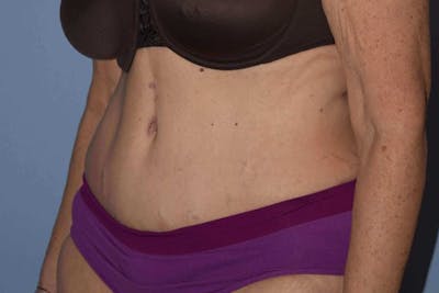 Tummy Tuck Before & After Gallery - Patient 173577913 - Image 6