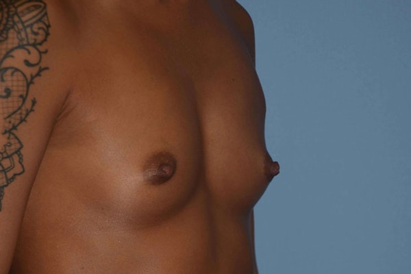 Breast Augmentation Before & After Gallery - Patient 173578633 - Image 3