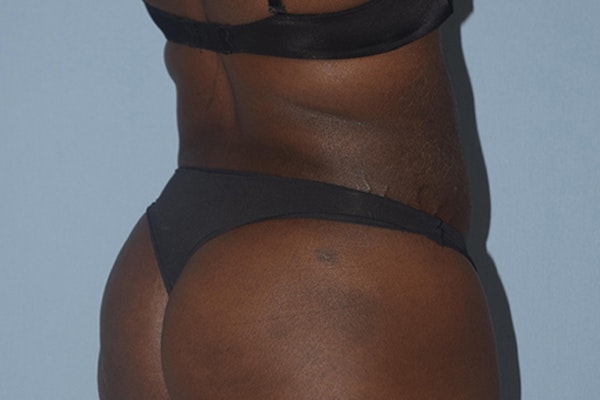 Liposuction Before & After Gallery - Patient 173577912 - Image 8