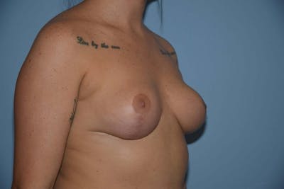 Breast Reduction Before & After Gallery - Patient 173583328 - Image 4