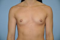 Breast Augmentation Before & After Gallery - Patient 173623662 - Image 1
