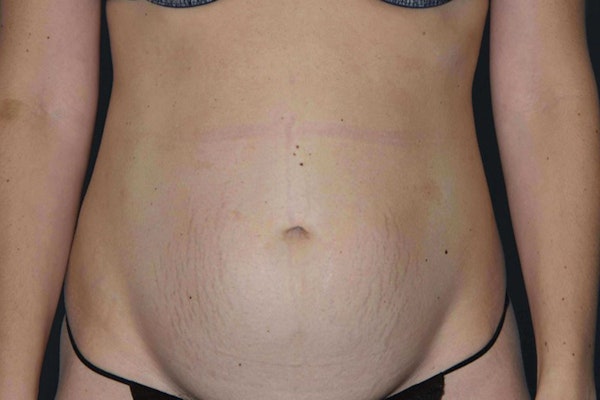 Tummy Tuck Before & After Gallery - Patient 173605827 - Image 1