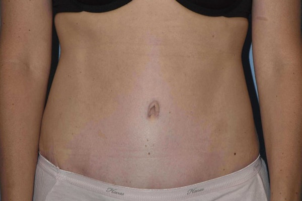 Tummy Tuck Before & After Gallery - Patient 173605827 - Image 2