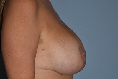 Breast Augmentation Lift Before & After Gallery - Patient 173583329 - Image 10
