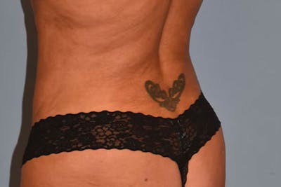 Liposuction Before & After Gallery - Patient 173605826 - Image 4