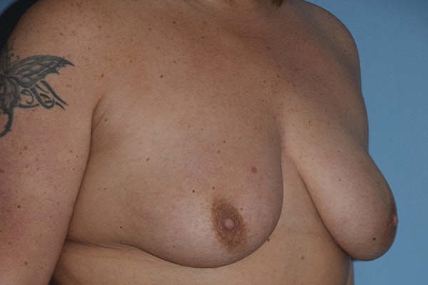 Breast Augmentation Lift Before & After Gallery - Patient 173605829 - Image 3