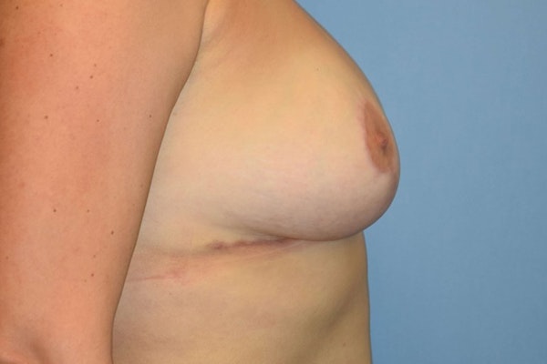 Breast Reduction Before & After Gallery - Patient 173605830 - Image 6