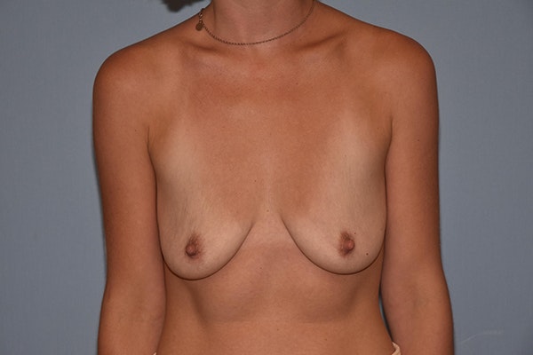 Breast Augmentation Lift Before & After Gallery - Patient 173623663 - Image 1