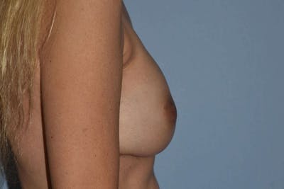 Breast Reconstruction Before & After Gallery - Patient 173605831 - Image 6