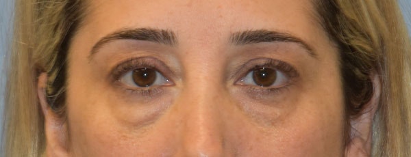 Eyelid Lift Before & After Gallery - Patient 173623658 - Image 1