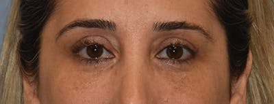 Eyelid Lift Before & After Gallery - Patient 173623658 - Image 2