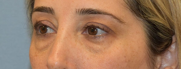 Eyelid Lift Before & After Gallery - Patient 173623658 - Image 3