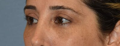Eyelid Lift Before & After Gallery - Patient 173623658 - Image 4