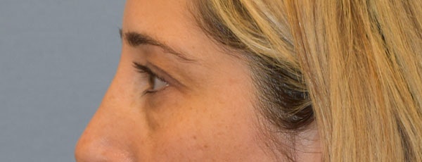 Eyelid Lift Before & After Gallery - Patient 173623658 - Image 5