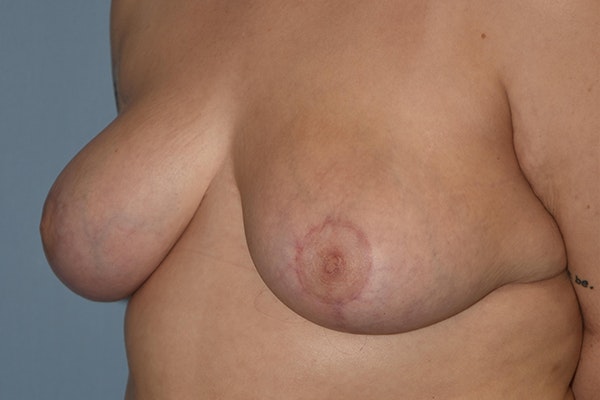 Breast Reduction Before & After Gallery - Patient 173623657 - Image 6