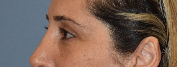 Eyelid Lift Before & After Gallery - Patient 173623658 - Image 6