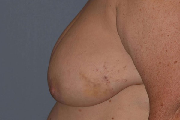 Breast Reconstruction Before & After Gallery - Patient 173623660 - Image 5