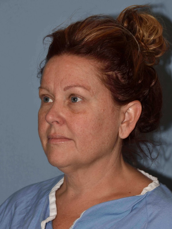 Facelift Before & After Gallery - Patient 173623681 - Image 5