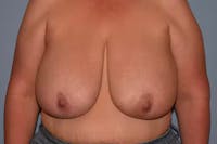 Breast Reduction Before & After Gallery - Patient 173623668 - Image 1