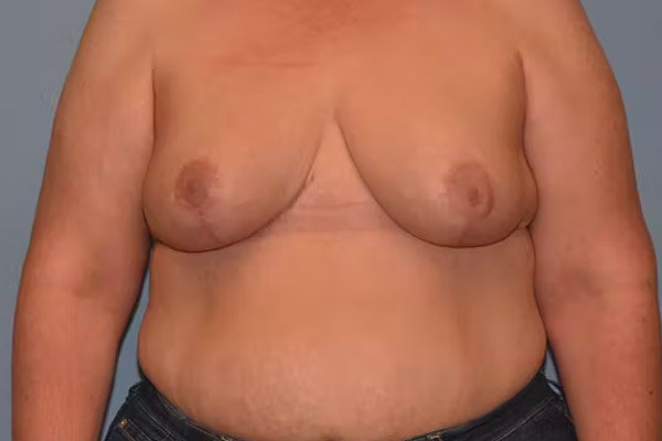 Breast Reduction Before & After Gallery - Patient 173623668 - Image 2