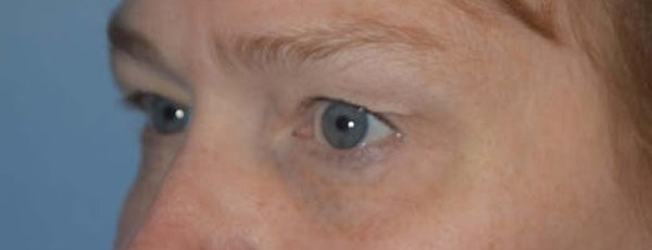 Eyelid Lift Before & After Gallery - Patient 173623664 - Image 3